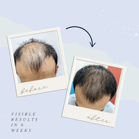 Before and after comparison of hair growth treatment on a person's head with text indicating visible results in 6 weeks.